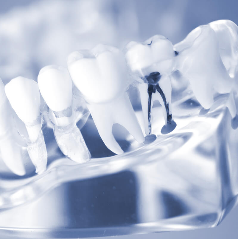 根管治療<wbr>（歯内療法）